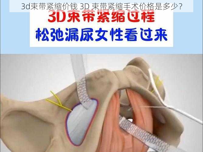 3d束带紧缩价钱 3D 束带紧缩手术价格是多少？